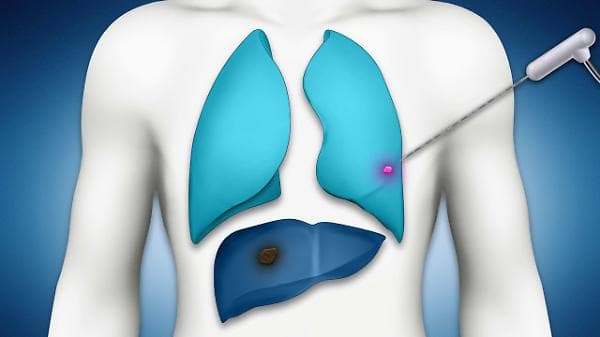termoablazione oncologica una metodica da scoprire